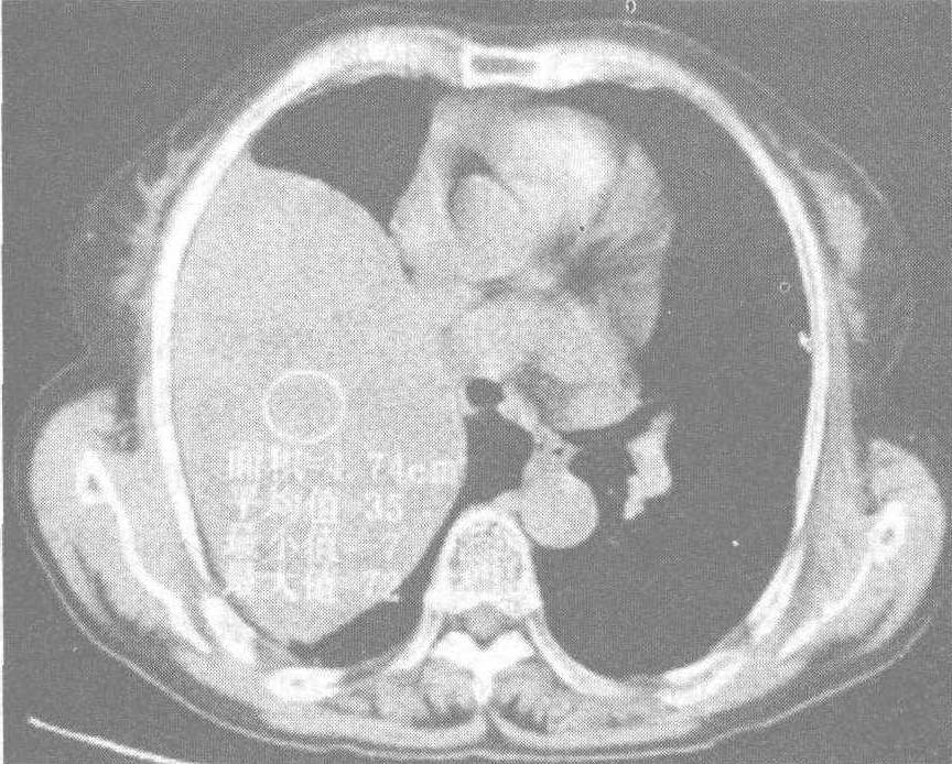 病例8 胸膜巨大纤维瘤